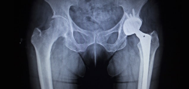 X ray image of hip