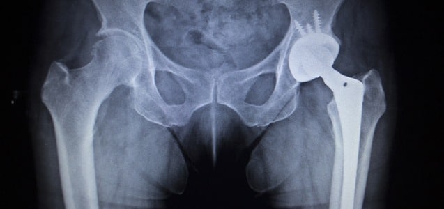 X-Ray of Hip