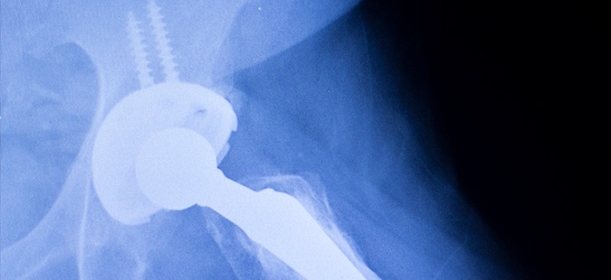 hip joint xray