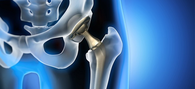 metal hip