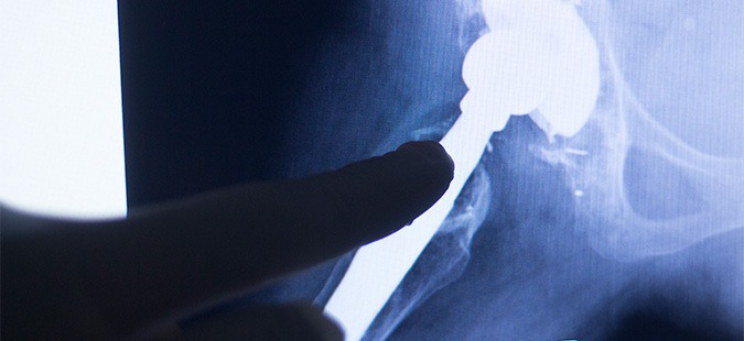 hip-implant-close-up-x-ray